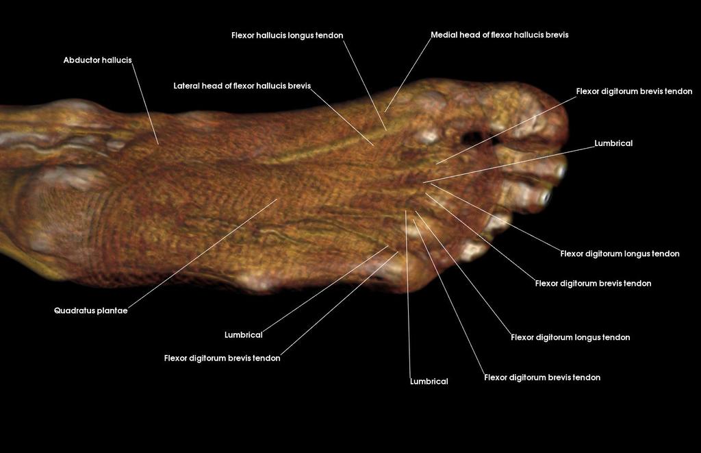 malleolus Tibialis posterior tendon 3. d.