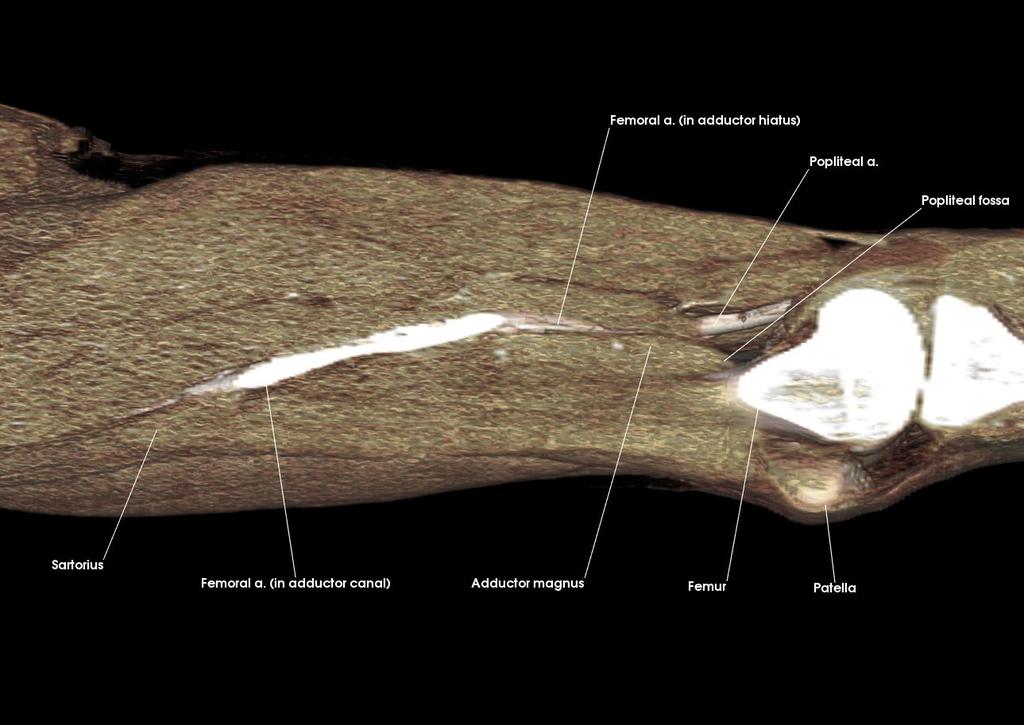 Adductor magnus Femoral a. (in adductor canal) Femoral a. (in adductor hiatus) Femur Patella Popliteal a. Popliteal fo