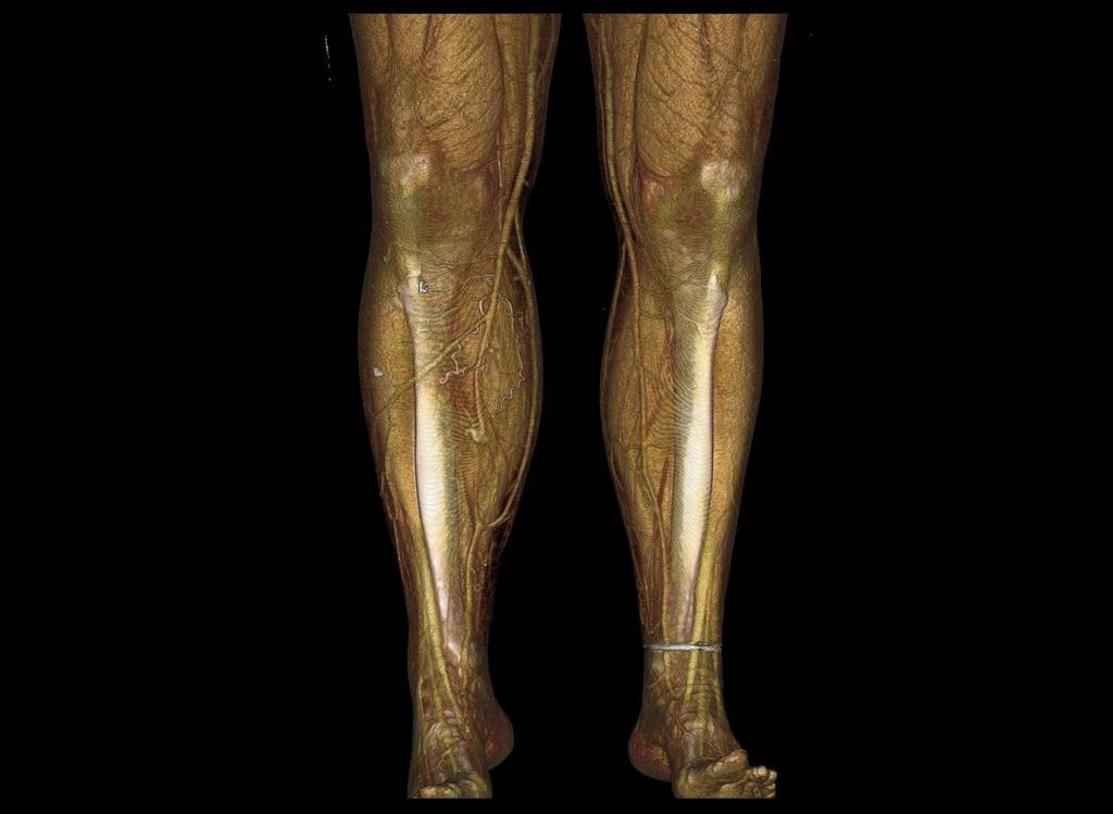 Suggested Clinical Correlates (CC): Varicose Veins Venous