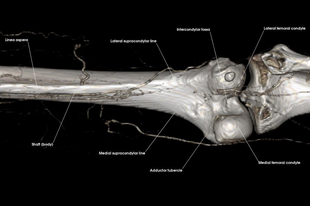 Posterior Proximal Femur Adductor tubercle Lateral ep