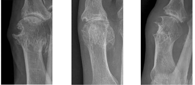 X-ray: Typical Gouty Erosions The characteristic gouty erosion is both destructive and