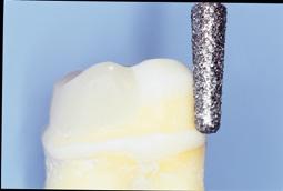 and natural dentine. Placing the LuxaPost with LuxaCore Z-Dual as the cement.