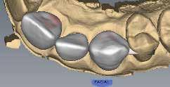Anterior Bridge If there are any hangups, adjustments need to be made to the Spacer on the Design tab. Call Customer Support for help on your first few cases of hangups on Bridges.