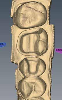 For Your Information 4 Start on the most distal preparation. Two examples of multiple restoration models shown below.