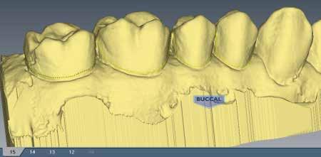 Pre-op Editing This case uses scans of the preoperative teeth for occlusion information. 1 Click Pre-op Editing.