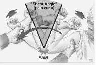History Medial elbow pain Pain during acceleration phase of throwing (85%) more commonly
