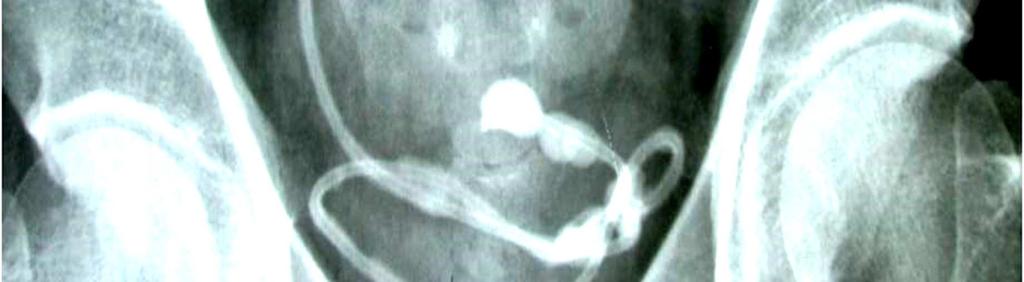 The urinary bladder was partially distended with stent seen in situ.