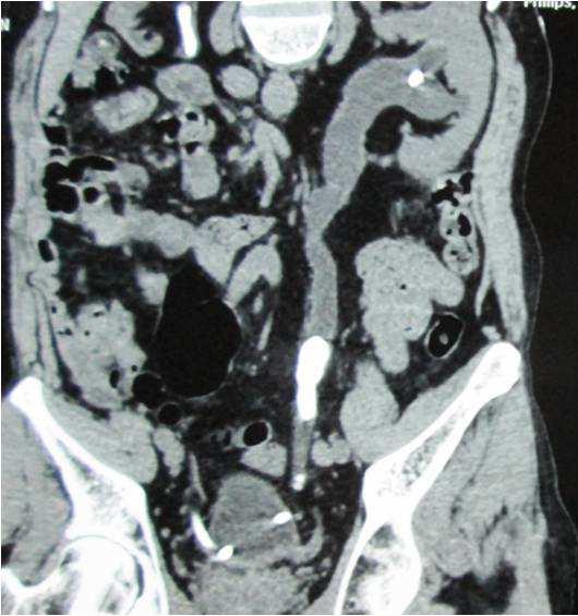 Right renal calculi with DJ stent noted in situ with encrustation and
