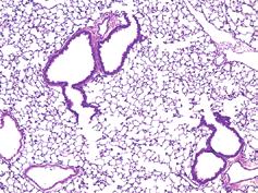 leukocyte Eosinophil Total leukocyte