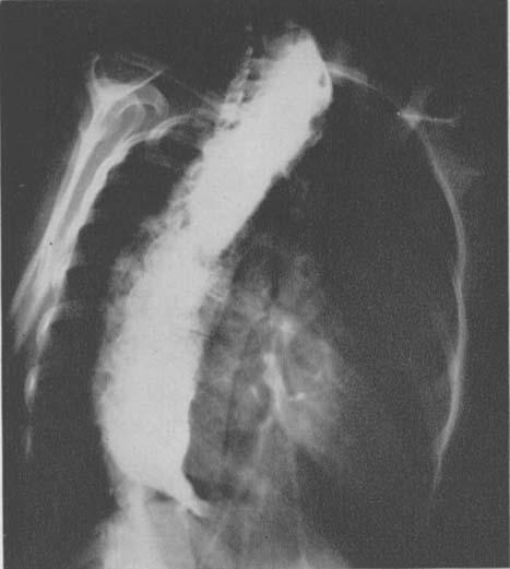 CASE REPORT: A B FIG. 1. (A) Plain x-ray prior to first operation shows deviation of thick-walled esophagzis into the right chest. (B, C) An esophagram shows barium mixed with retained food.