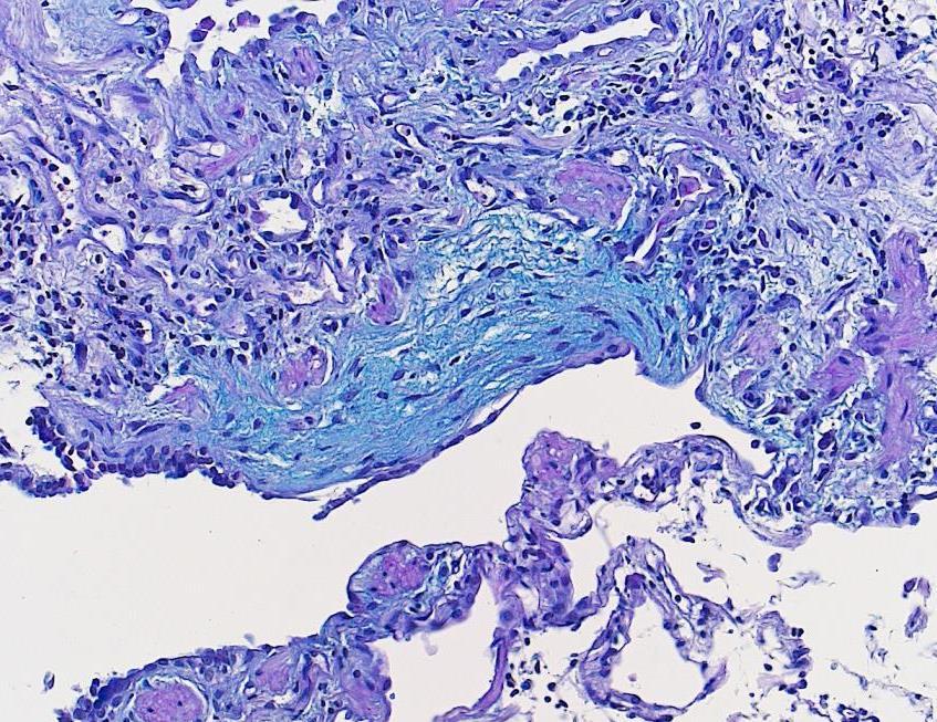 Absence of marked inflammation, granulomas Fibroblastic focus: Edematous fibroblastic tissue