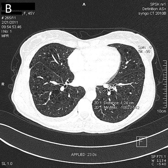 Histopathologic study of the lung specimen taken during the right open lung biopsy demonstrated features of emphysema, numerous hemosiderin-laden macrophages and interstitial infiltration of cells
