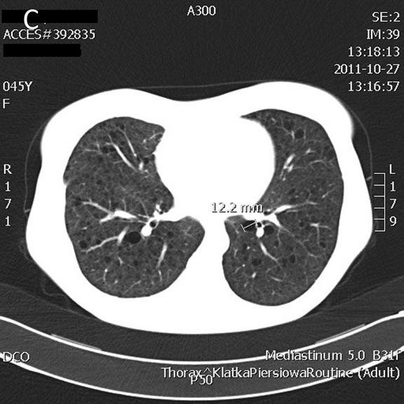 This finding was consistent with the diagnosis of pulmonary LAM. Based on previous reports (10,11), sirolimus was administered to the patient.