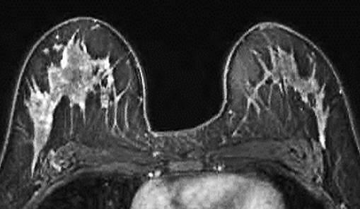 BPE in preoperative breast MRI 377 Fig. 3 A 41-year-old premenopausal woman with invasive ductal carcinoma of the left breast who underwent preoperative breast MRI.