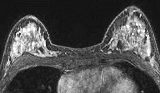 4 A 40-year-old premenopausal woman with invasive ductal carcinoma of the left breast who underwent preoperative breast MRI. The tumor is not shown on the image.