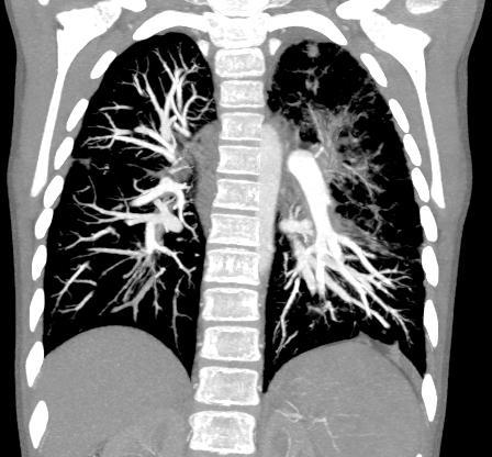 pulmonary HTN and