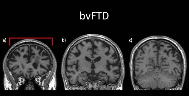 Frontotemporal Dementia Neurodegeneration mainly involving Frontal and Temporal lobes Progressive change in personality and behaviour or progressive deterioration in language