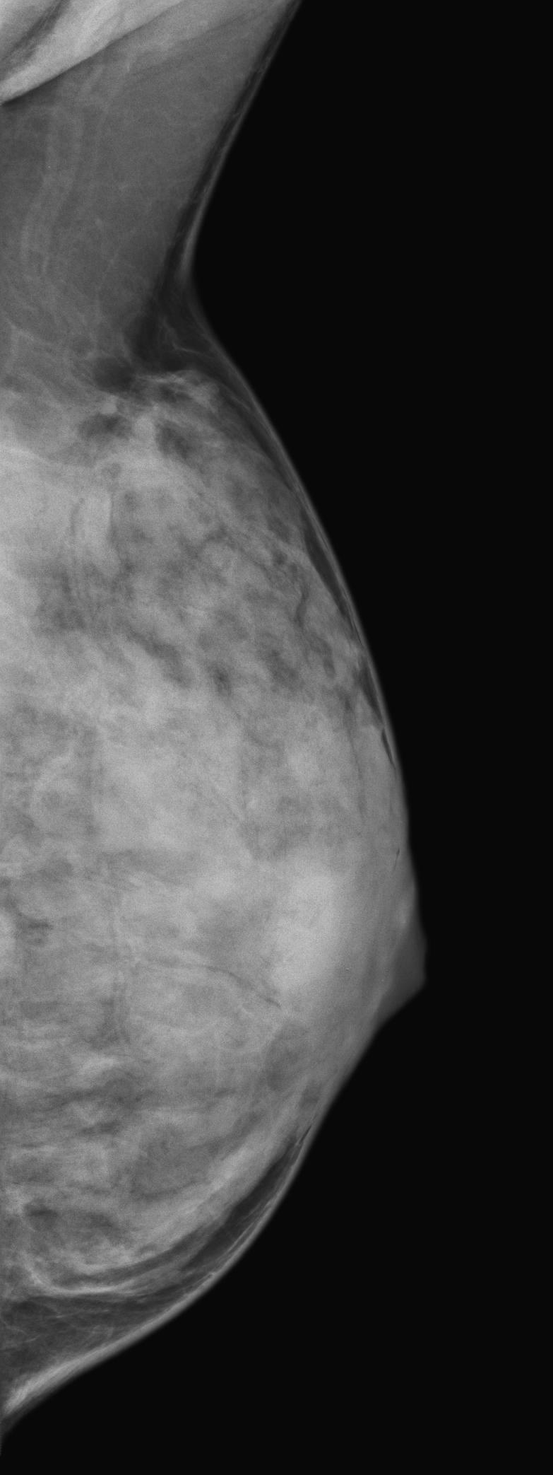 No Indication for Breast MRI: Screening low-risk patients