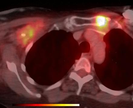 FDG PET/CT test of choice for restaging suspected