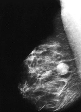 Breast US Indications The most useful adjunct to mammography
