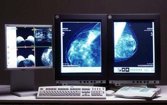 Screening Mammography became clinically available in 1970 Mammography is the only screening test proven to