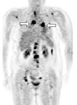PET -Positron emission tomography PET is primarily used as a modality to delineate the