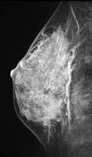 visible with DBT. 4 yo with lump in left breast.