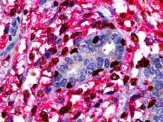 Breast Tumors Usually B-cell
