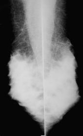Mammary Amyloid Tumor Rare Mass Mammographic