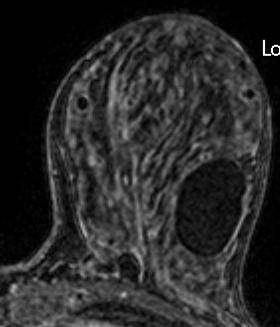 Benign Lesions Fibroadenoma Cysts Lymph
