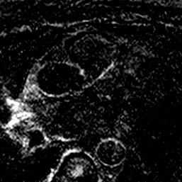 Contrast Enhanced Coronary MRI Inflammation Patient