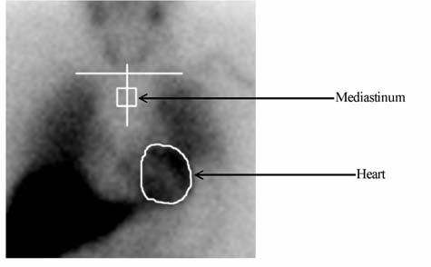 8 Estimation of the H/M Ratio among Patients with Congestive Heart Failure Initial evaluation of cardiac AdreView images involves visual examination of the location, pattern and intensity of cardiac