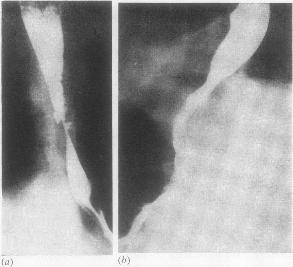 38 Moghissi Fig 1 Radiographs ofbarium swallows in the same patient (a) before and (b) after intrathoracic Nissen fundoplication.