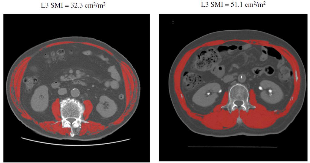 Hepatocellular carcinoma - survival 196 pt hepatocellular carcinoma undergoing hepatectomy, CT L3, 40% sarcopenic Harimoto.