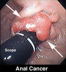 Anal Cancer Squamous cell carcinoma Surgical results poor Radiotherapy results poor