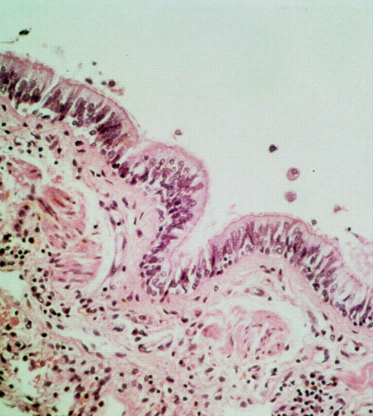 Normal airway Intact surface pseudostratified ciliated columnar epithelium Indistinct