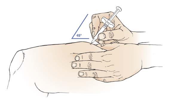 Do not use the prefilled syringe if it is dropped without the needle cover in place. Hold the barrel of your ORENCIA prefilled syringe in one hand between the thumb and index finger (see Figure G).