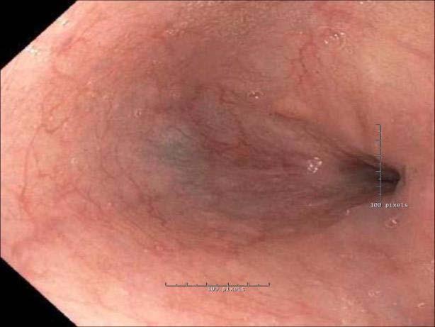Endoscopic Closure of Postoperative Gastrointestinal Leakage and Fistulas with OTSC 9 upper, 5 lower leaks 100% technical success 5