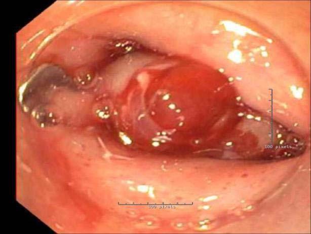Endoscopic Repair of Gastrogastric Fistula After RYGB