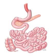Stenosis The most common sites of postoperative stenosis: Gastric band