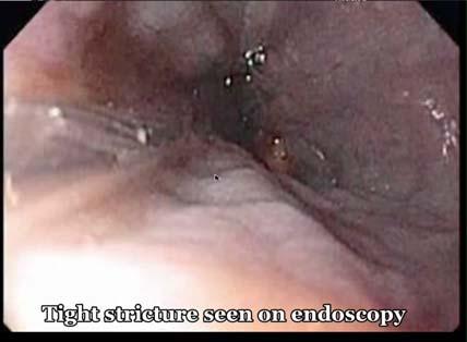 Endoscopy for Stricture Management Dilation with balloons Bougie dilators for chronic, longsegment Stenosis Staged TTS balloon dilation to 15 mm 2-4 sessions Start 4 wks post op and repeat q2-3 wks