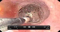 Endoscopy for Stricture Management Response rates up to 90% for early strictures Etiologies?