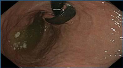 endoscopic devices can be used to remove sutures and staples Bands: VBG vs LAGB Surgery may be needed LAGB: