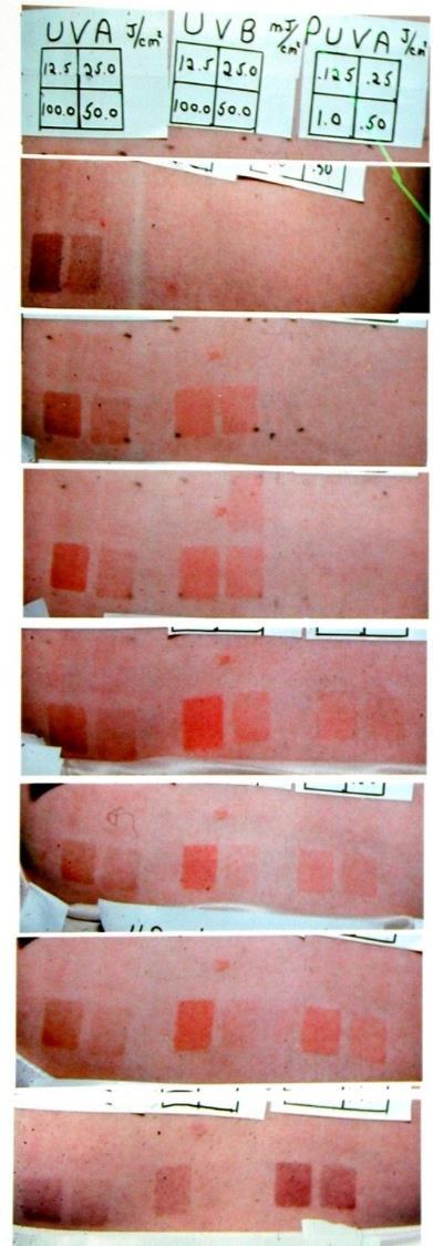UVA, UVB, PUVA-induced Skin Changes 0 h 2 h 5 h 24