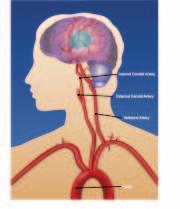 An ischemic stroke is caused when blood flow is blocked either by a blood clot that forms in the heart or on a hardened fatty buildup (atherosclerotic plaque) in one of the larger blood vessels going