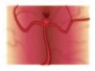 What causes an aneurysm to bleed? We usually don t know why an aneurysm bleeds or exactly when it will bleed.