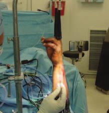 position to aid in the treatment of distal radius