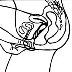 the sheath and the vaginal wall.) Step 9: To take out the female condom, grasp the outer ring, twist it to seal in the fluid and gently remove.