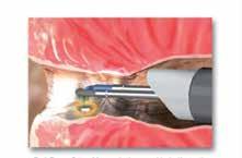 New and more gentle Plasma-OvalButton Vaporization Therapy The Plasma-OvalButton represents the forefront of innovation of the surgical treatment options available for BPH.