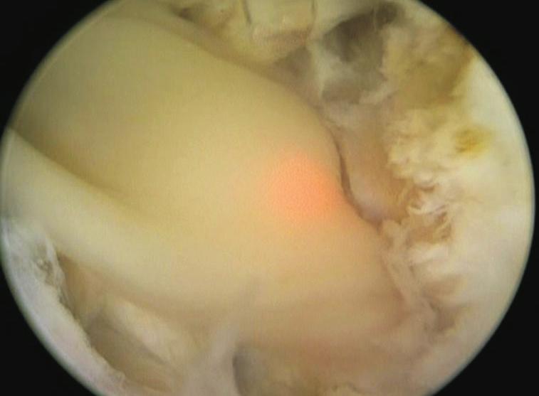Holmium laser deroofing of a prostatic abscess surgical interventions, such as open perineal drainage, transrectal ultrasound (TRUS)-guided needle aspiration, and transurethral resection of the